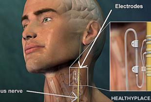 Vagus nerve stimulation is for treatment-resistant depression. Learn about VNS therapy, vagus nerve stimulation side effects and cost.